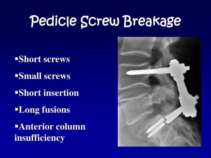 pedicle screw problems - how often are pedicle screws removed