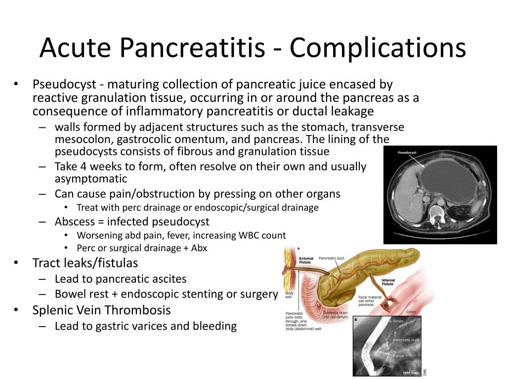Se puede comer marisco con pancreatitis