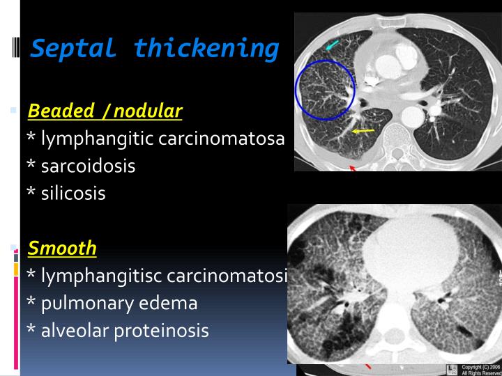 PPT - Dr Ahmed Refaey , FRCR PowerPoint Presentation - ID:3113600