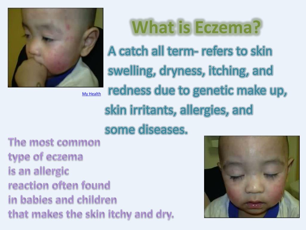 PPT - Skin Disorder Project Eczema Honors Anatomy and Physiology ...