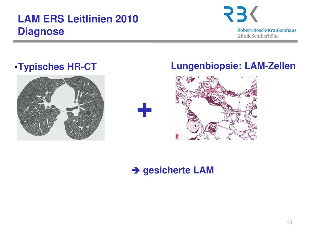 PPT - Lymphangioleiomyomatose (LAM) Physiotherapie bei LAM Stefanie ...