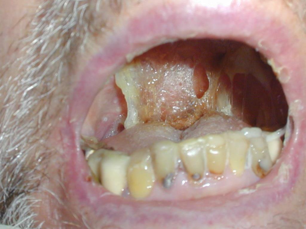PPT DYSPHAGIA AND ORAL CARE ISSUES AT THE END OF LIFE PowerPoint