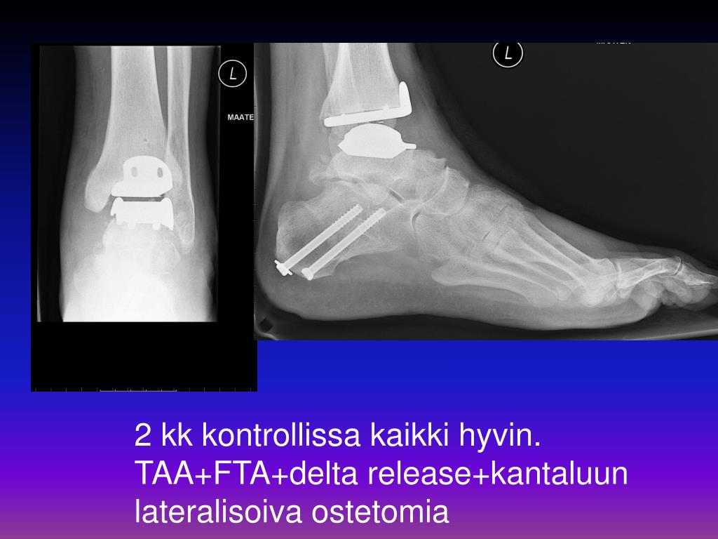 PPT Nilkkaproteesi Total Ankle Arthroplasty TAA PowerPoint PPT Nilkkaproteesi Total Ankle Arthroplasty TAA PowerPoint