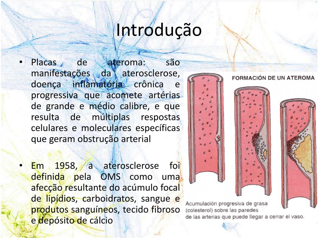 O Que é Ateromatose Intracraniana - BRAINCP