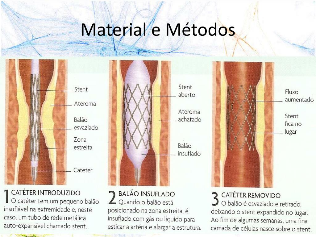 O Que é Ateromatose Intracraniana - BRAINCP