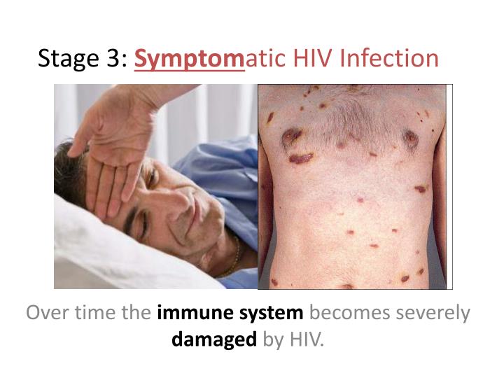 Stages Of Hivaids Infection 