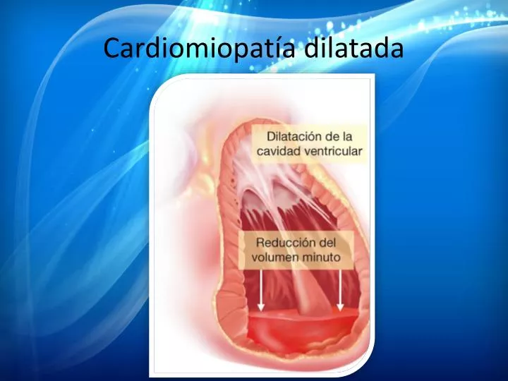 PPT - Cardiomiopatía Dilatada PowerPoint Presentation, Free Download ...