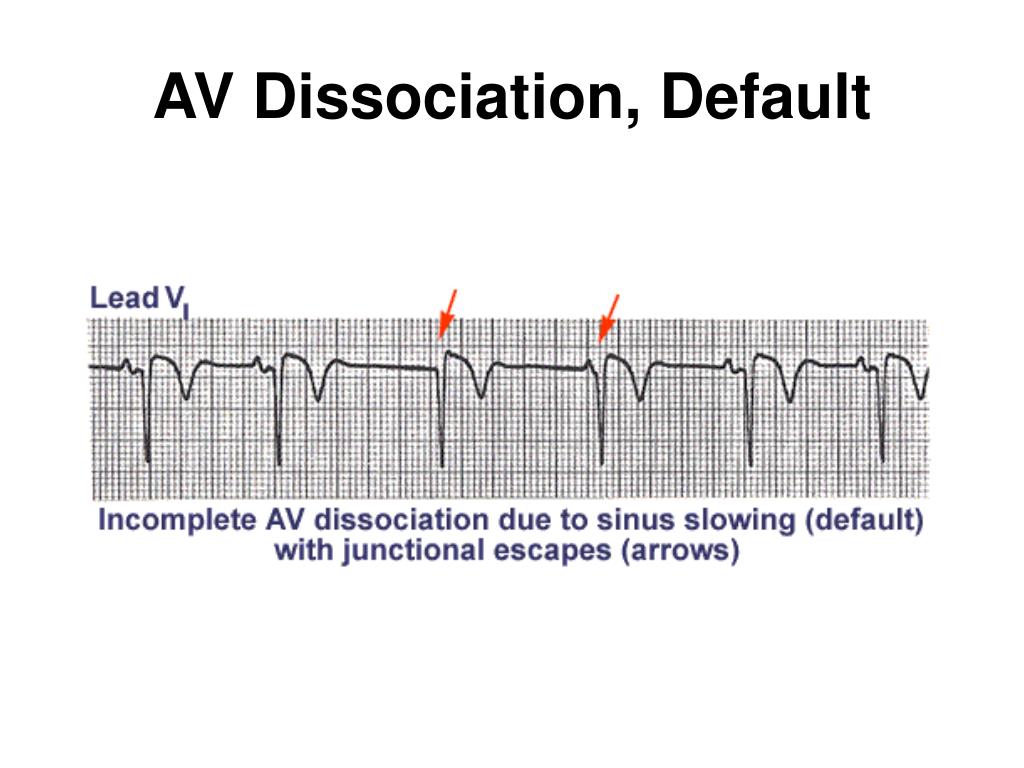 PPT EKG Conduction Abnormalities Part II PowerPoint Presentation PPT EKG Conduction Abnormalities Part II PowerPoint Presentation