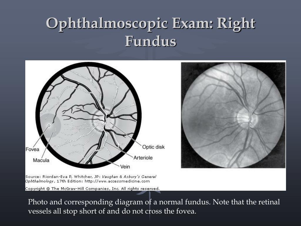 Dilated Fundus Exam Dfe Dr David Lelonek Dilated Fundus Exam Dfe Dr David Lelonek