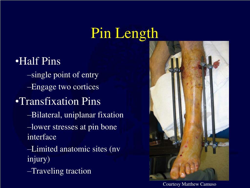 PPT - Principles of External Fixation PowerPoint Presentation, free  download - ID:3201240