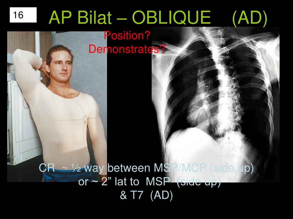 PPT - PA -anterior side BEST SEEN AP -posterior side BEST SEEN ...