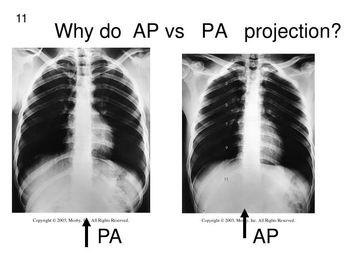 PPT - PA -anterior side BEST SEEN AP -posterior side BEST SEEN ...