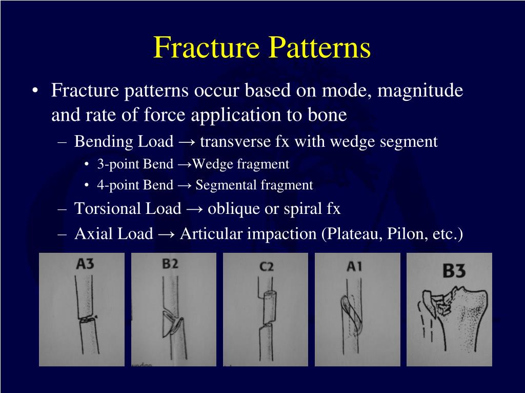 PPT Basic Principles and Techniques of Internal Fixation of Fractures