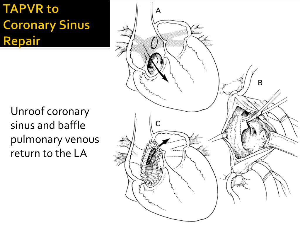 PPT - Cardiac Surgical Anomalies in the Neonate PowerPoint Presentation ...