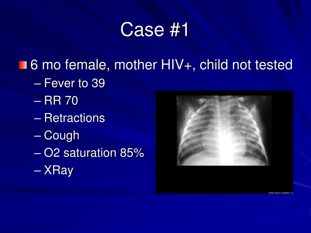 PPT - Review of HIV and Opportunistic Infections (OI) in Children ...