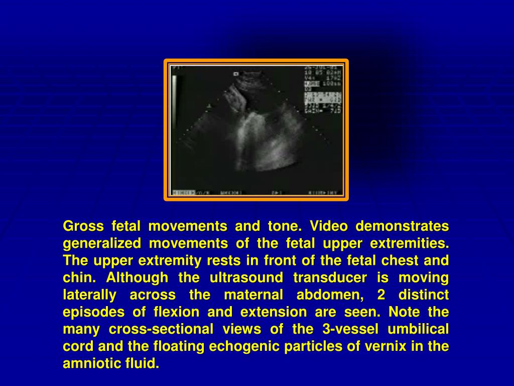 PPT Fetal Biophysical Profile in high risk pregnancy PowerPoint
