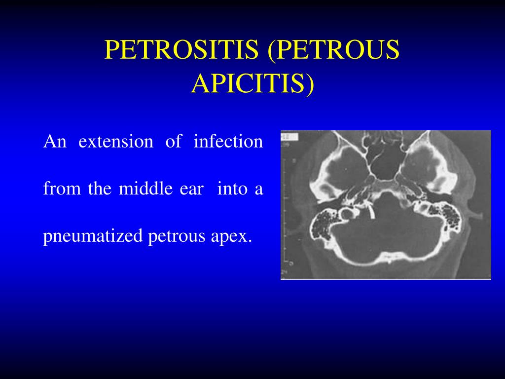 Ppt Complications Of Suppurative Otitis Media Powerpoint Presentation
