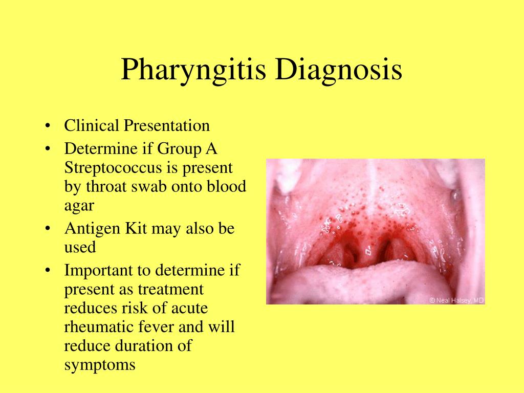 Ppt Upper Respiratory Tract Infections Powerpoint Presentation Free