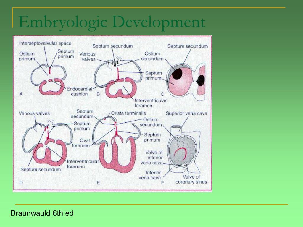 PPT - First Do No Harm: Management of Atrial Septal Defect in Adult ...
