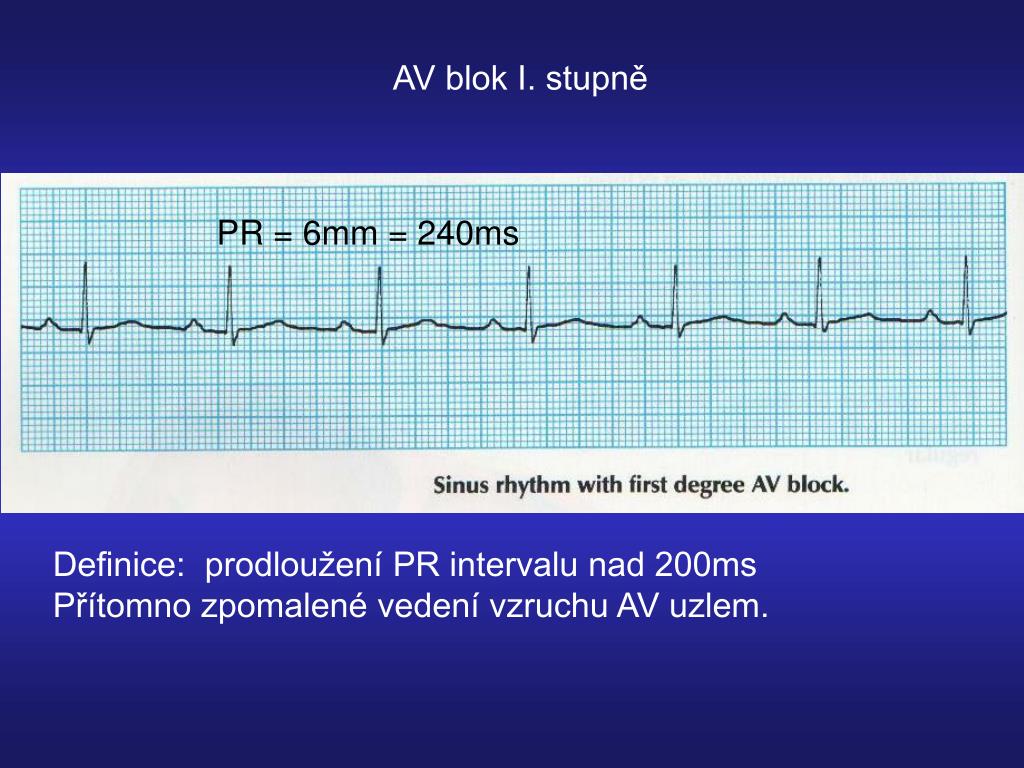 PPT - EKG - bradykardie PowerPoint Presentation, free download - ID:3257130