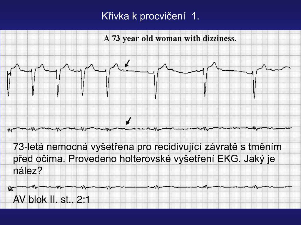PPT - EKG - bradykardie PowerPoint Presentation, free download - ID:3257130
