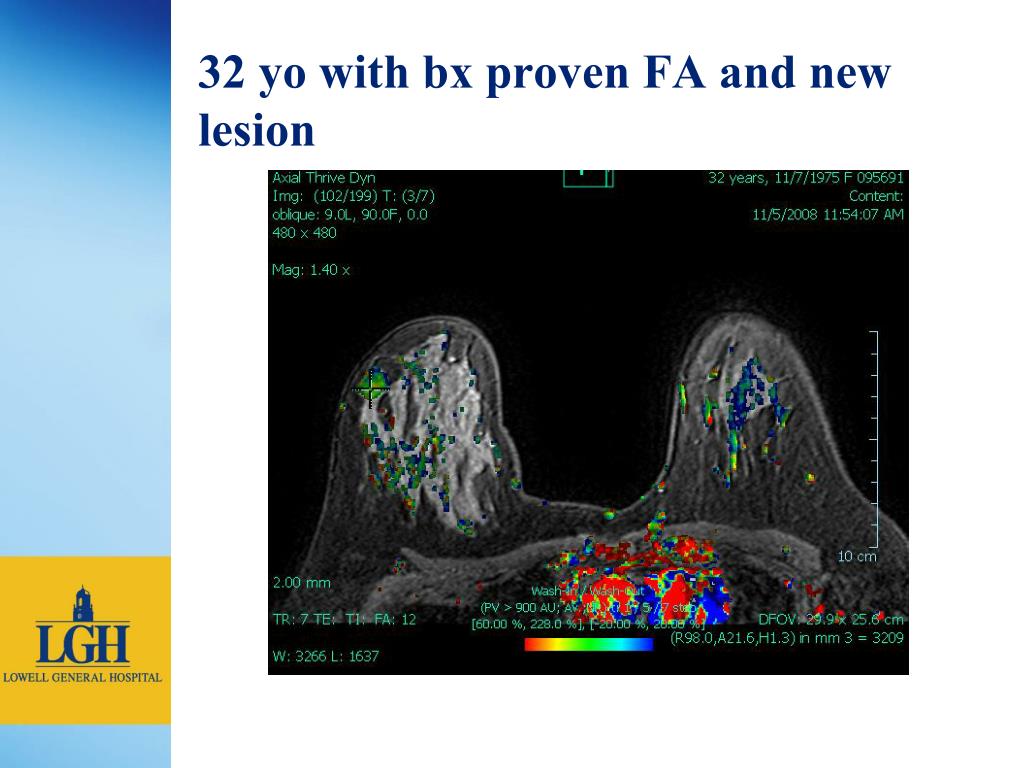 PPT - Breast MRI at Lowell General Hospital PowerPoint Presentation ...