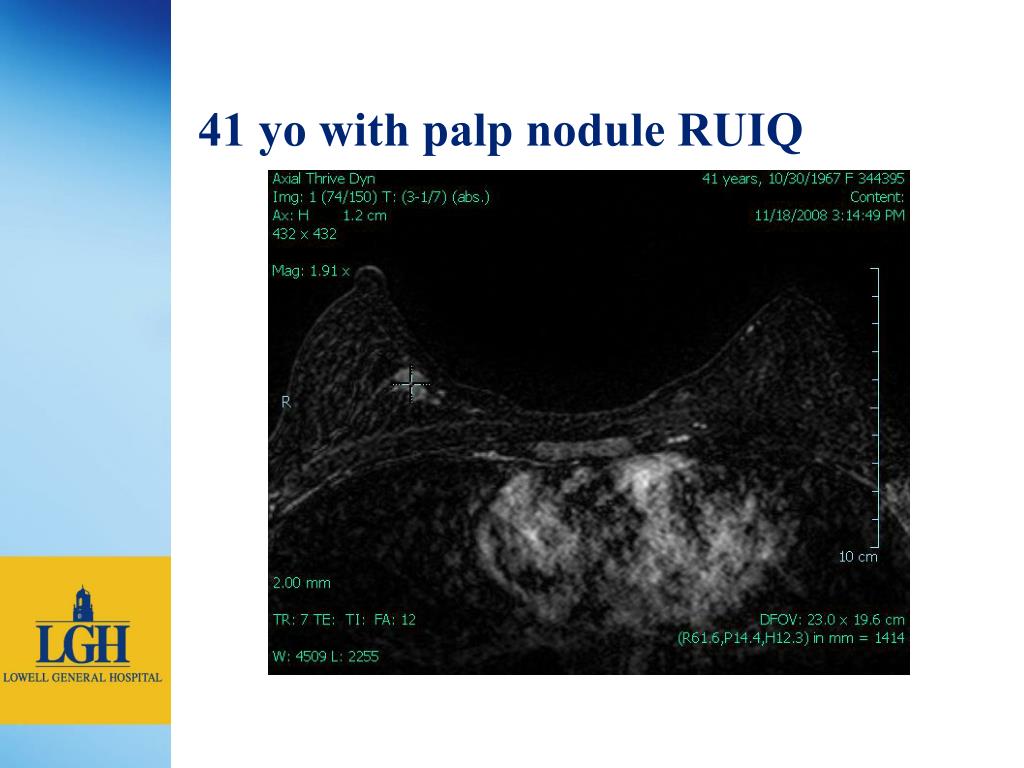 PPT - Breast MRI at Lowell General Hospital PowerPoint Presentation ...