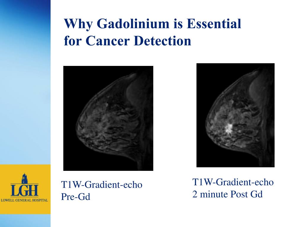 PPT - Breast MRI at Lowell General Hospital PowerPoint Presentation ...