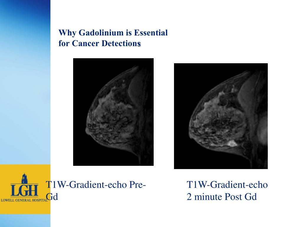 PPT - Breast MRI at Lowell General Hospital PowerPoint Presentation ...