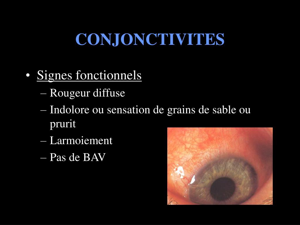 PPT URGENCES OPHTALMOLOGIQUES PowerPoint Presentation, free download ID3260207