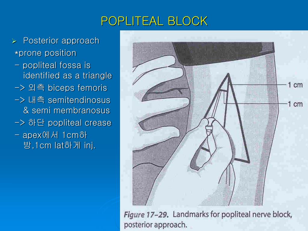 PPT - Peripheral nerve block techniques for ambulatory surgery