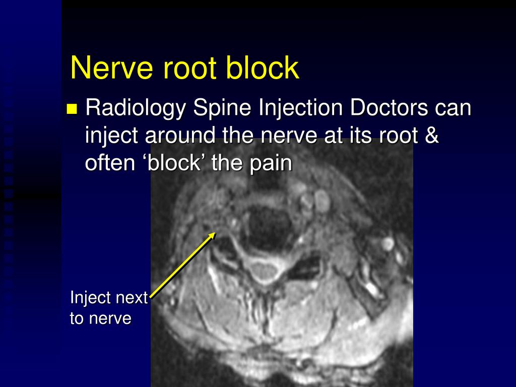 Ppt Cervical Nerve Root Block Powerpoint Presentation Free Download