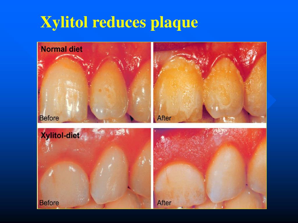 PPT Prevention of motherchild transmission of mutans streptococci