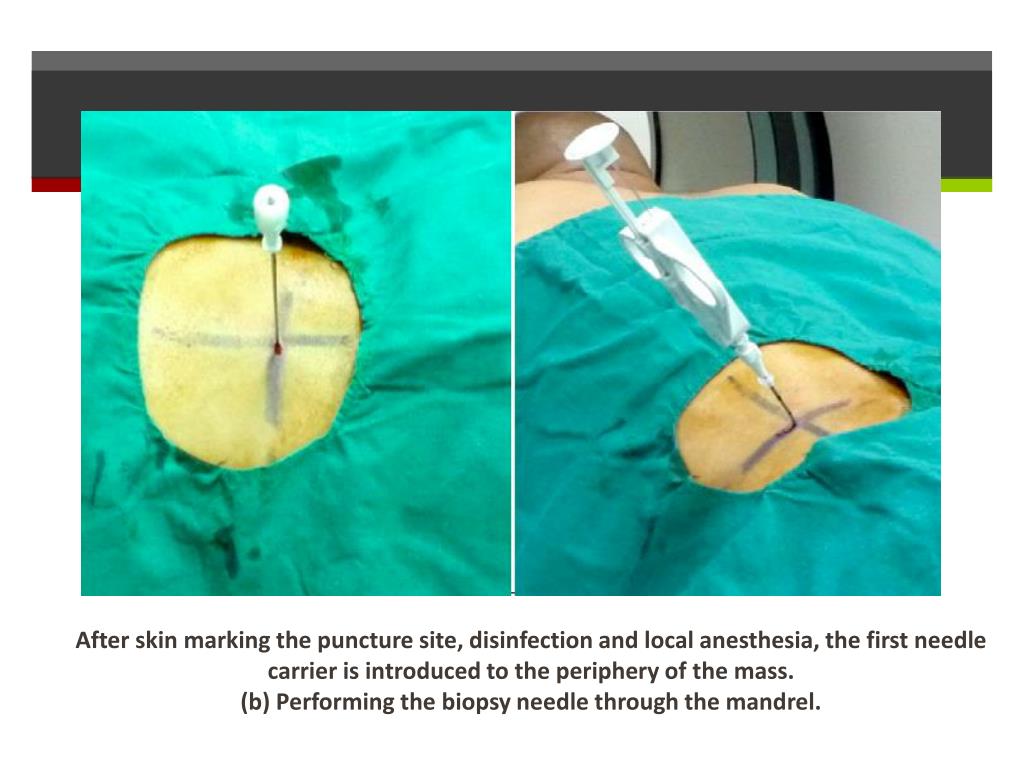 PPT - GUIDED PERCUTANEOUS BIOPSY OF RETROPERITONEAL LESIONS PowerPoint ...