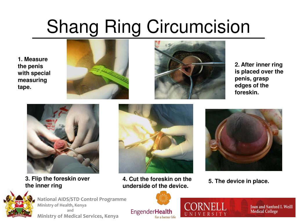 PPT - Pilot Study of the Shang Ring: A Novel Male Circumcision Device for  HIV Prevention PowerPoint Presentation - ID:3281485