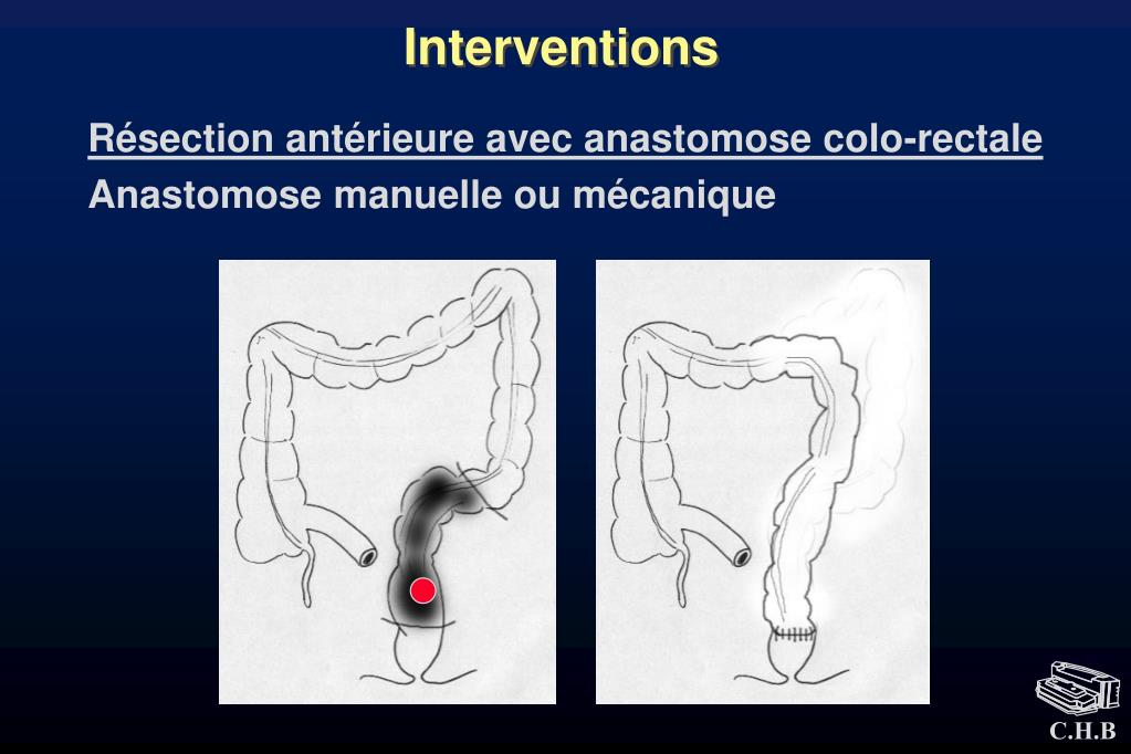 PPT - Chirurgie du rectum PowerPoint Presentation, free download -  ID:3281796