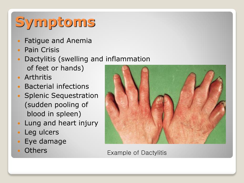 PPT - Sickle Cell Anemia PowerPoint Presentation, free ...