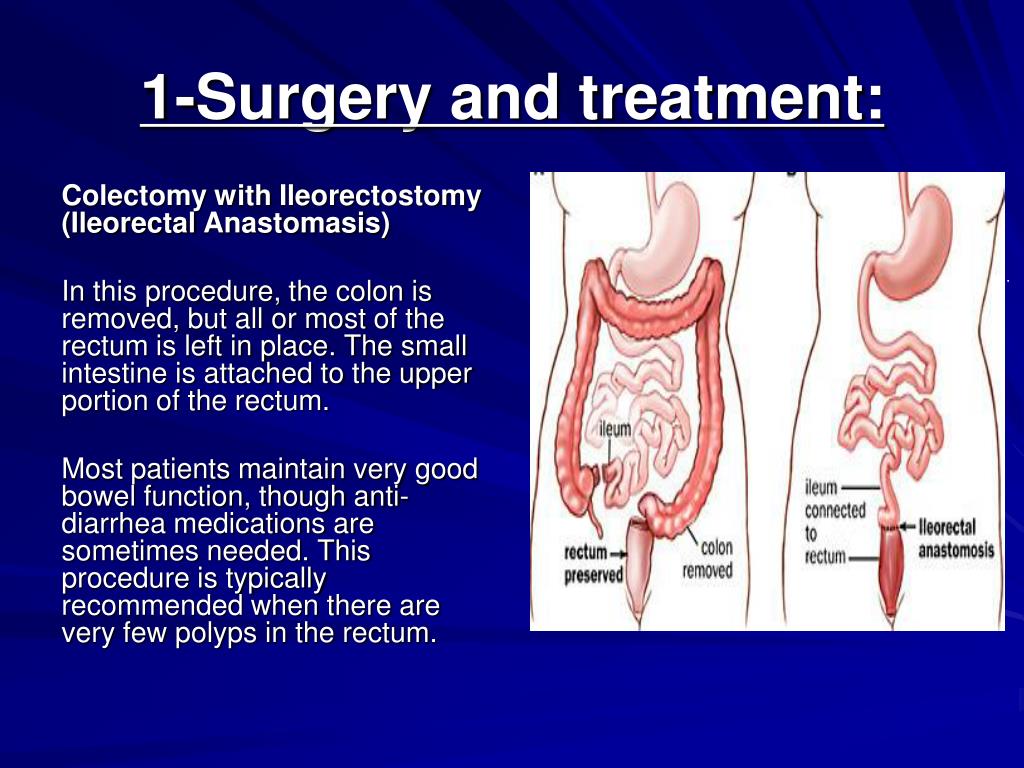Colectomy and ileostomy vrogue co