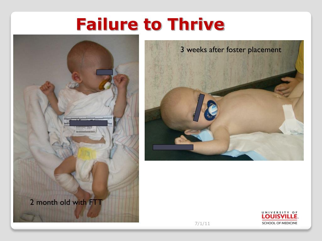 failure to thrive meaning infants