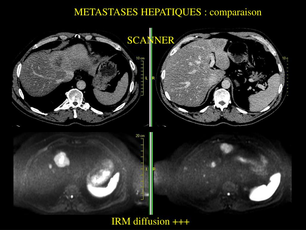 Peut On Voir Des Metastases Sur Un Scanner