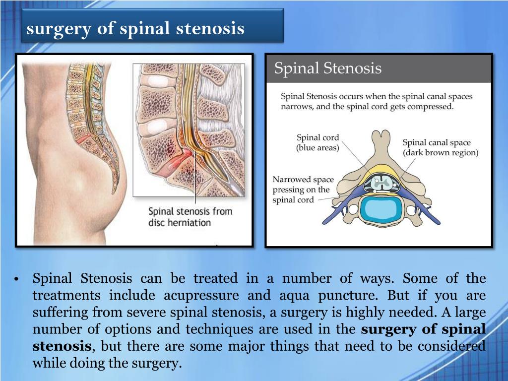 Spine Anatomy Spinal Stenosis
