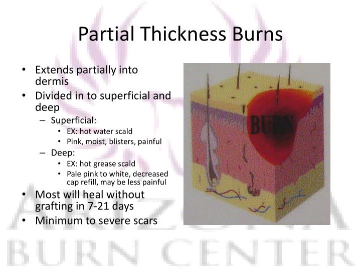 Ppt Burns In The Emergency Department Powerpoint Presentation Id3314883 6843