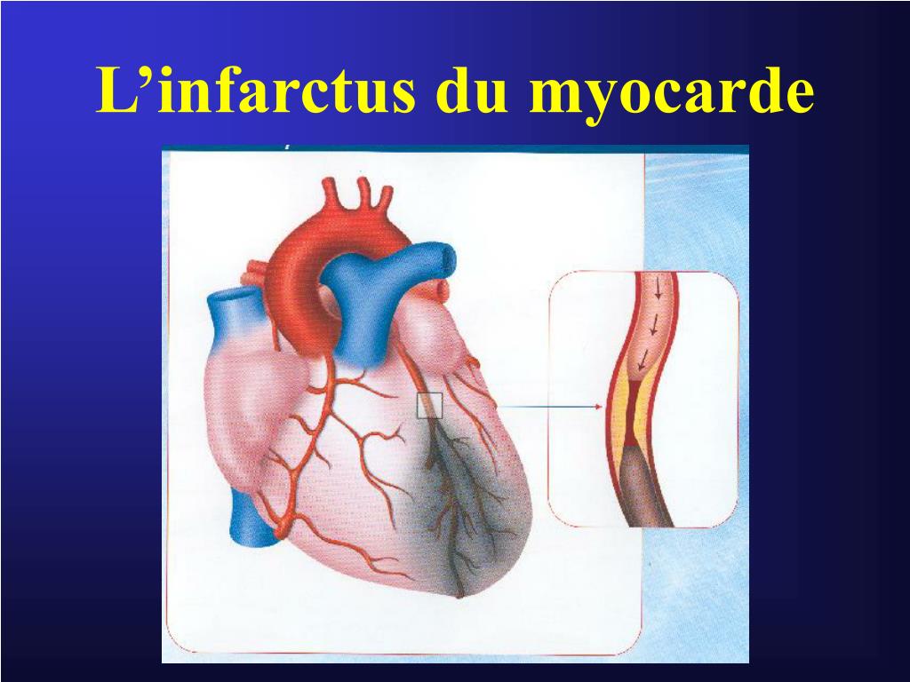 PPT  L’infarctus du myocarde PowerPoint Presentation, free download