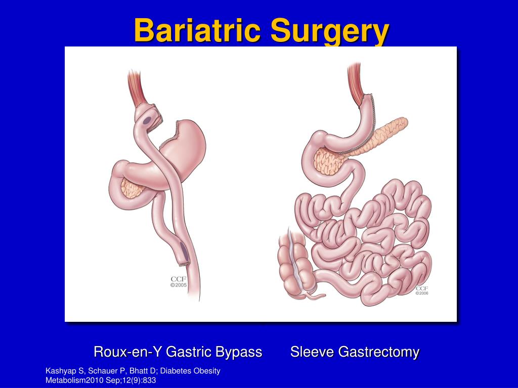 PPT Bariatric Surgery vs. Intensive Medical Therapy in