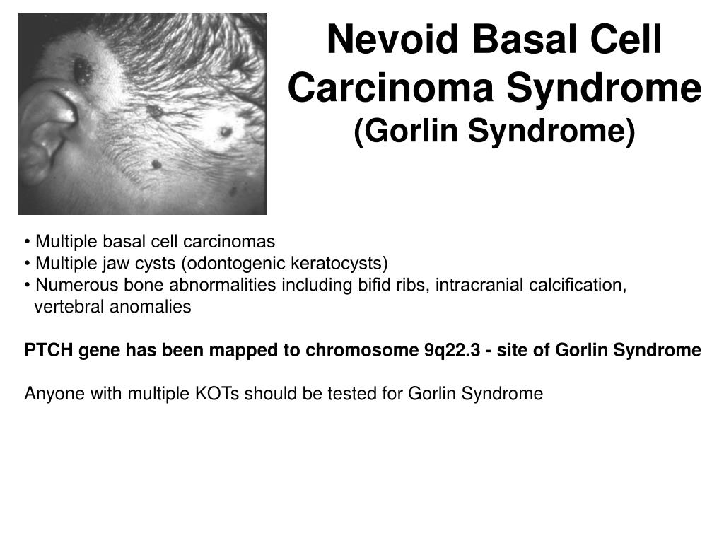 Nevoid Basal Cell Carcinoma Syndrome