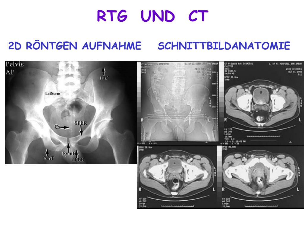 PPT - BECKEN (KNOCHEN UND BÄNDER) ARTICULATIO COXAE PowerPoint ...