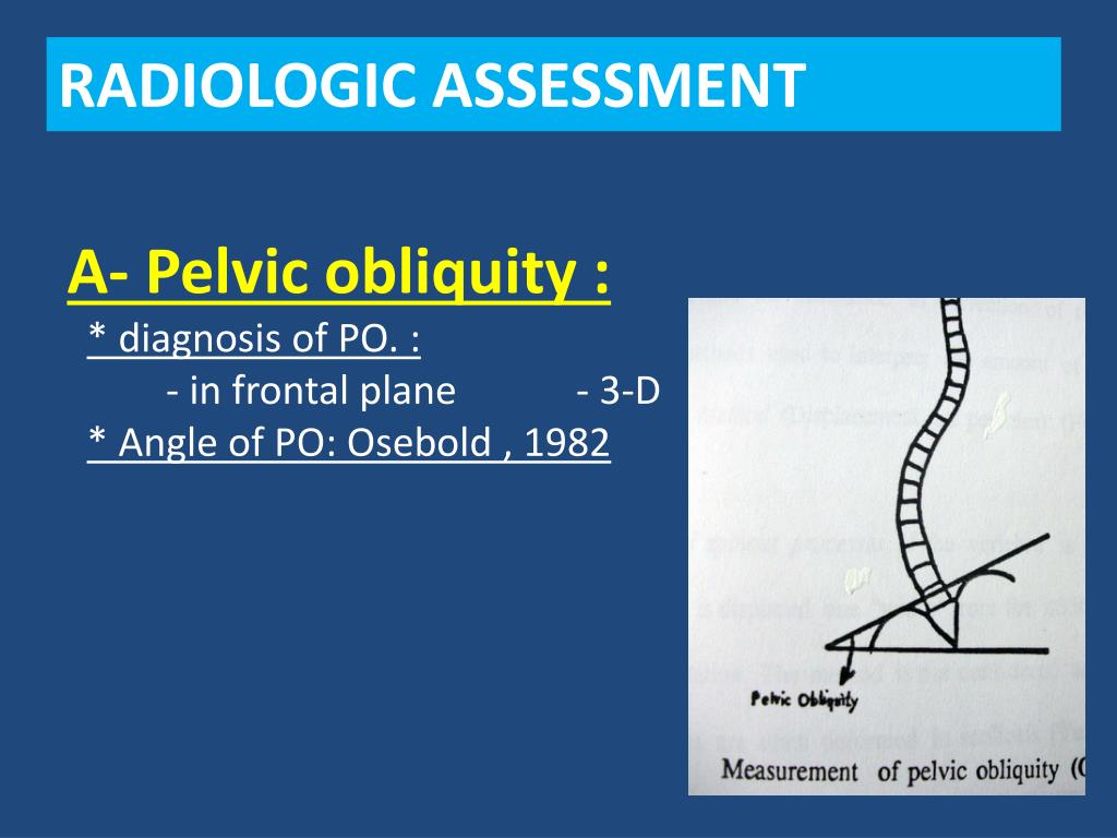 Ppt Pelvic Obliquity Powerpoint Presentation Free Download Id3331016
