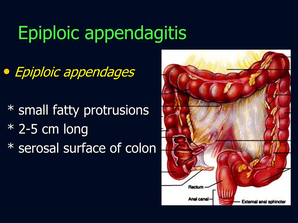 Appendagitis Epiploica Bilder Acute Epiploic Appendagitis ELTOE
