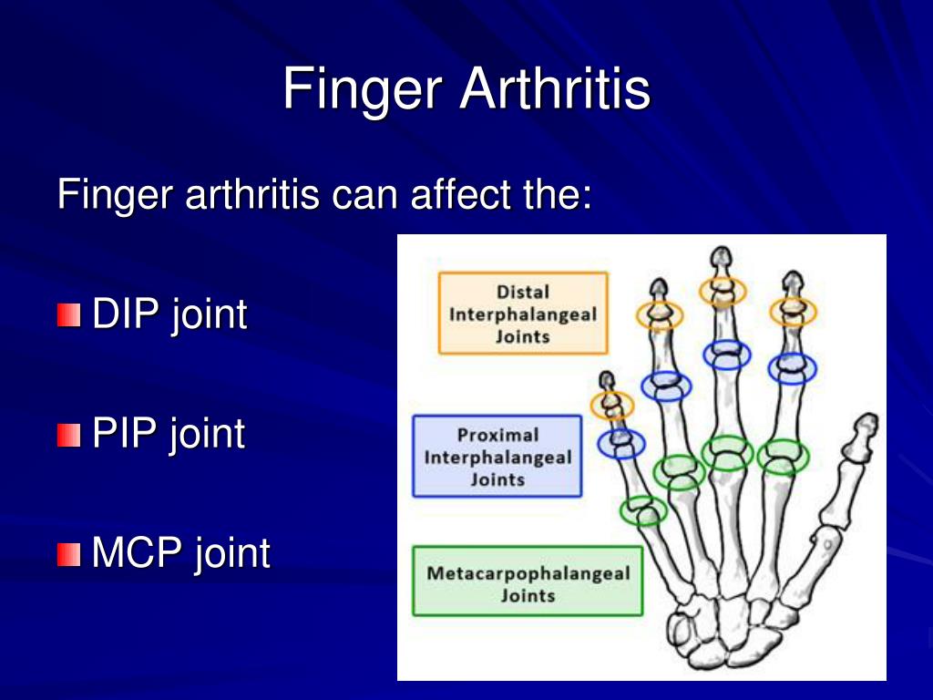 Ppt Hand And Wrist Arthritis Powerpoint Presentation Free Download