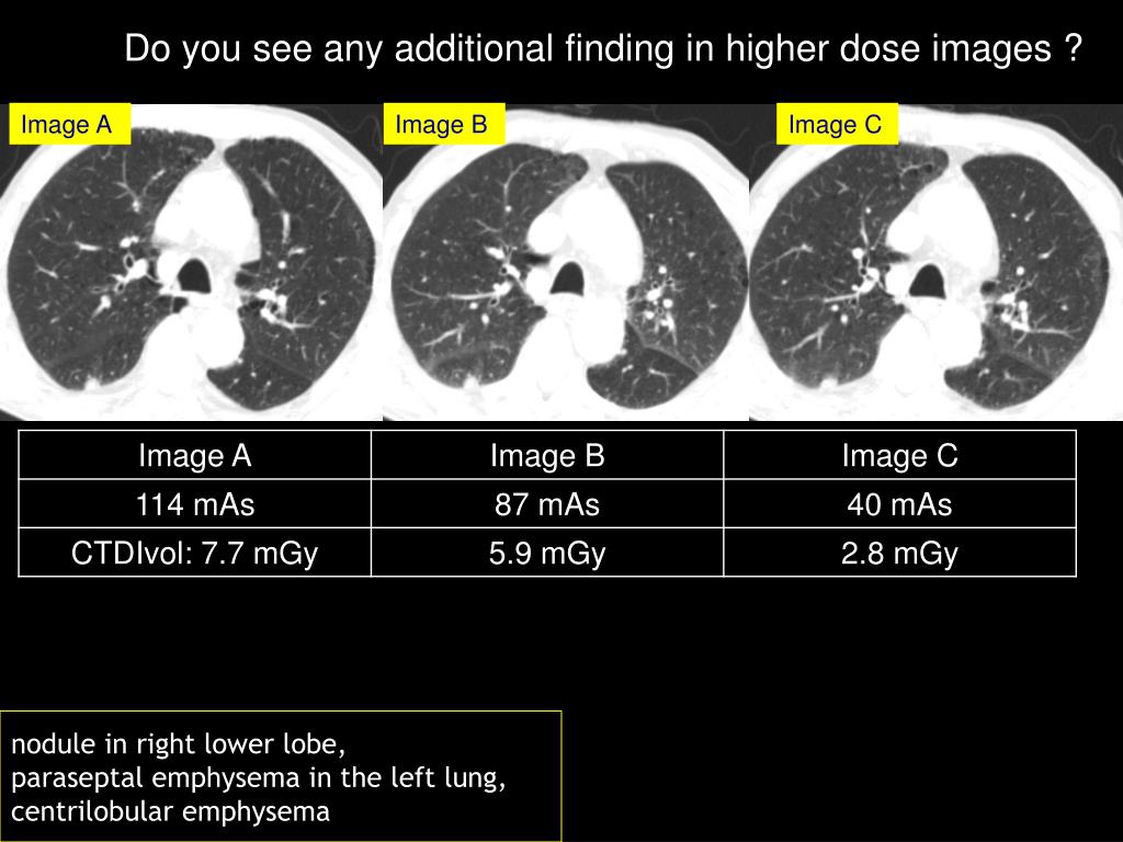 Ppt Image Gallery Lesion Detection On Low Dose Chest Ct Powerpoint